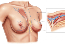What Is a Breast Lift? Breast Lift