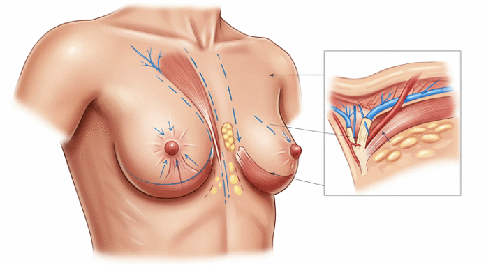 Breast Lift Breast Lift