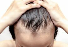 Effective Ways of Treating Male Baldness Treating Male Baldness