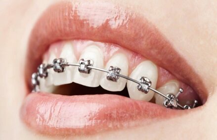Noticeable Advantages of Orthodontic Treatment