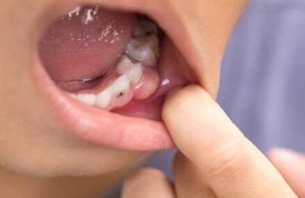 Tooth Abscess: Is It A Dental Emergency?