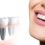 Dental Implant & Dental Bridges, Which One Is the Best to Replace Missing Teeth?