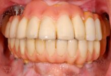 Complications and Risks of Dental Implants: What You Need to Know Dental Implants